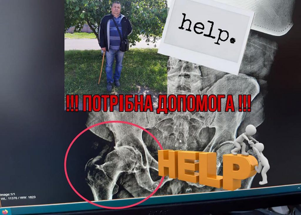 Голова сім'ї - 56-річний Костенюк Сергій Григорович - нещодавно переніс онкозахворювання, котре сильно послабило його організм. На фоні цього загострилась інша проблема: деструкція тазостегнового суглоба, викликана надмірним навантаженням на ноги.
